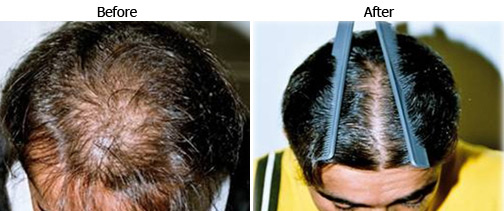 Best Hair Regrowth for men | Nubello Aesthetics