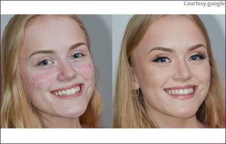 Acne Black Dark Spot Treatment In Navi Mumbai