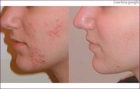 Acne Black Dark Spot Treatment In Navi Mumbai