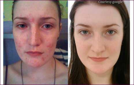 Acne Black Dark Spot Treatment In Navi Mumbai
