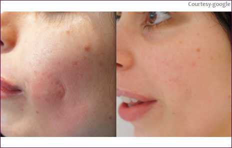 Acne Black Dark Spot Treatment In Navi Mumbai