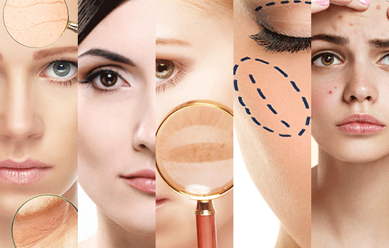 acne pigmentation scars and streatch marks treatment