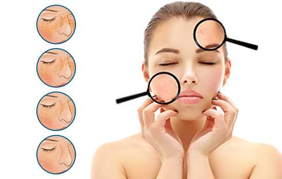 melasma laser treatment cost