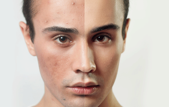 pigmentation laser removal