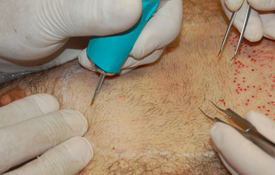 Body Hair Transplant Cost In Navi Mumbai