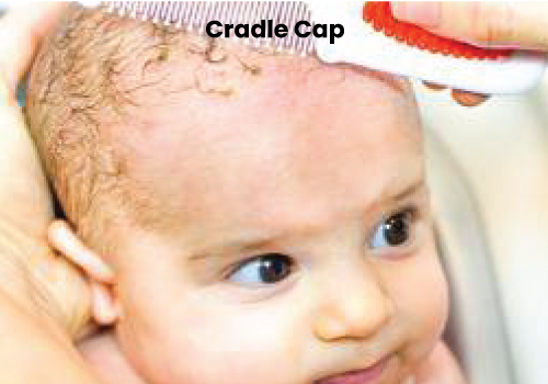 Dermatitis Treatment Centre In Navi Mumbai