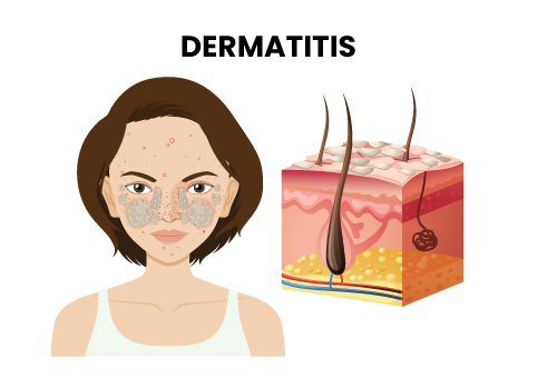 Dermatitis Treatment Centre In Navi Mumbai