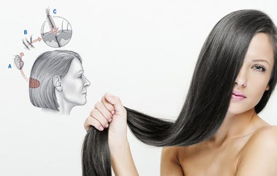 long hair transplantation procedure