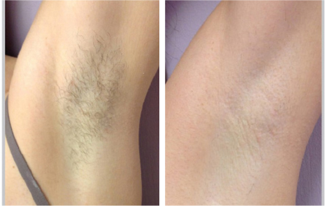 Female hair loss treatment in navi Mumbai