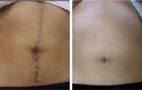 hair fall before and after images