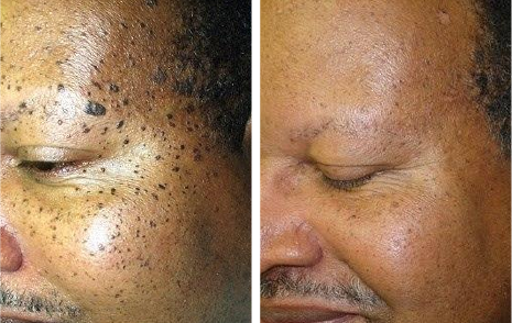 Female pattern baldness treatment in navi Mumbai