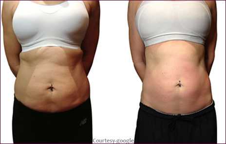 liposuction treatment for tummy tuck