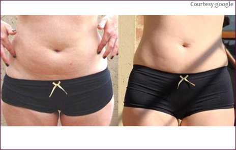 fat loss surgery in kharghar