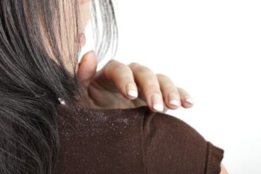 Best Tips To Remove Dandruff