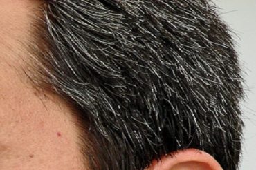 Graying-hair-premature