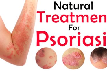 Psoriasis Treatment Process