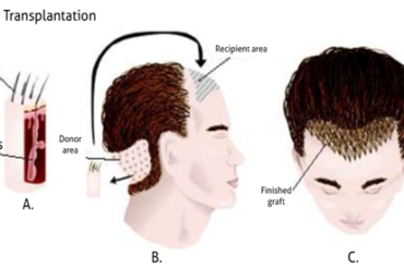 direct hair transplant techniques