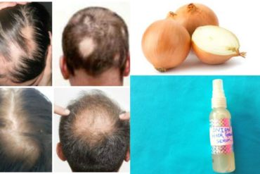 hair regrowth treatment