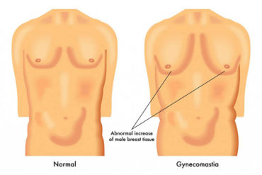 male breast surgery