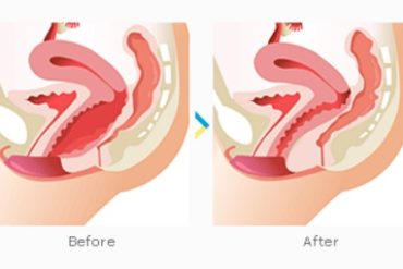 vaginal-tightening-surgery-before-and-after