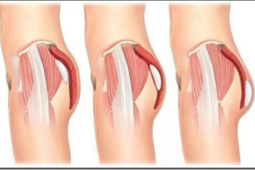 buttock_implant_placements