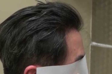 long hair transplant procedure