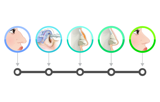 Procedure Rhinoplasty