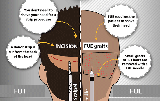 fut and fue procedure