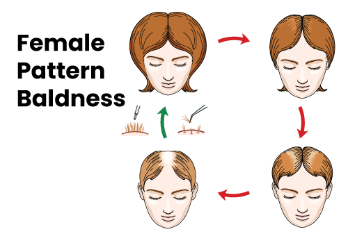 Female baldness info