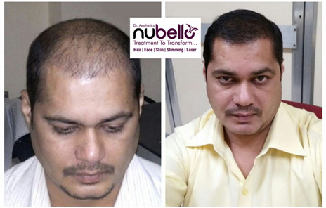 Hair Transplant In Navi Mumbai - Nubello Aesthetics Clinic