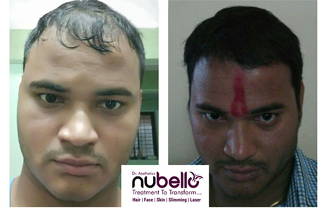 Best Mustache and Beard Transplant Treatment In Navi Mumbai - Nubello  Aesthetics Clinic